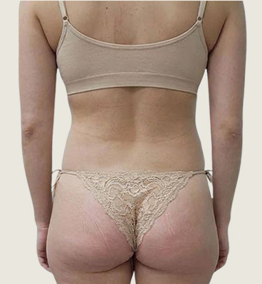 Before – Front