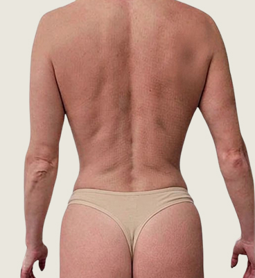 Before – Front