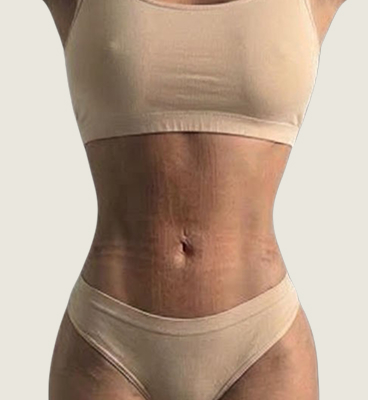 Snatched waist procedure before and after (rib recontouring), after 01, front view