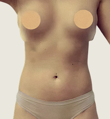 Snatched waist procedure before and after (rib recontouring), before 01, front view