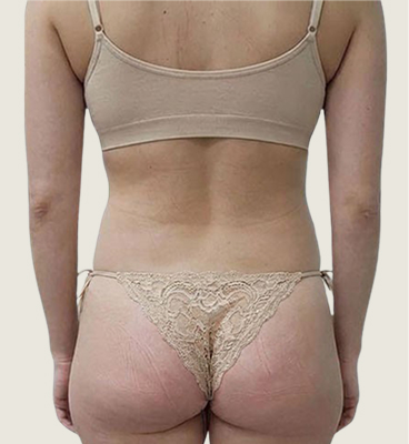 Snatched waist procedure before and after (rib recontouring), before 02, back view