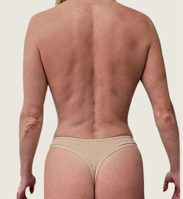 Snatched waist procedure before and after (rib recontouring), before 03, back view