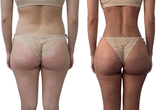 Is a Snatched Waist Permanent? How Long the Results Really Last